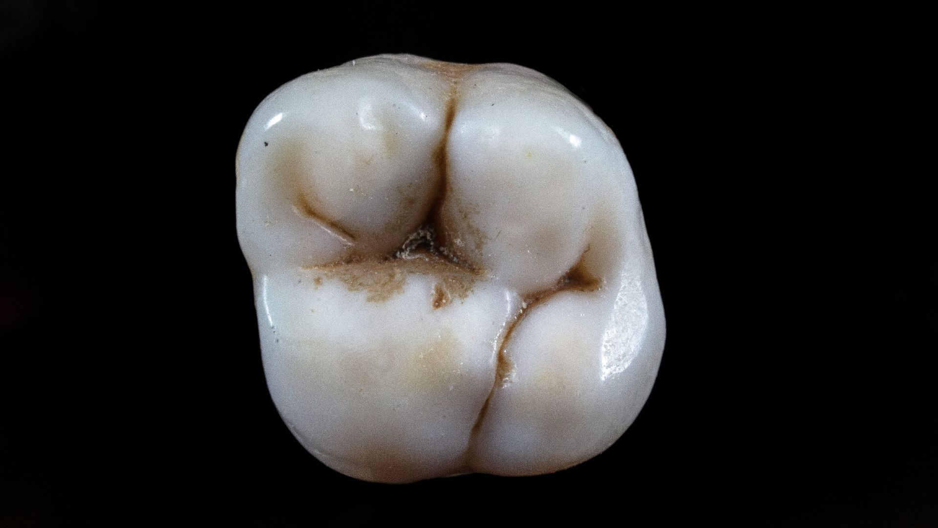 4. Votre risque de caries pourrait augmenter