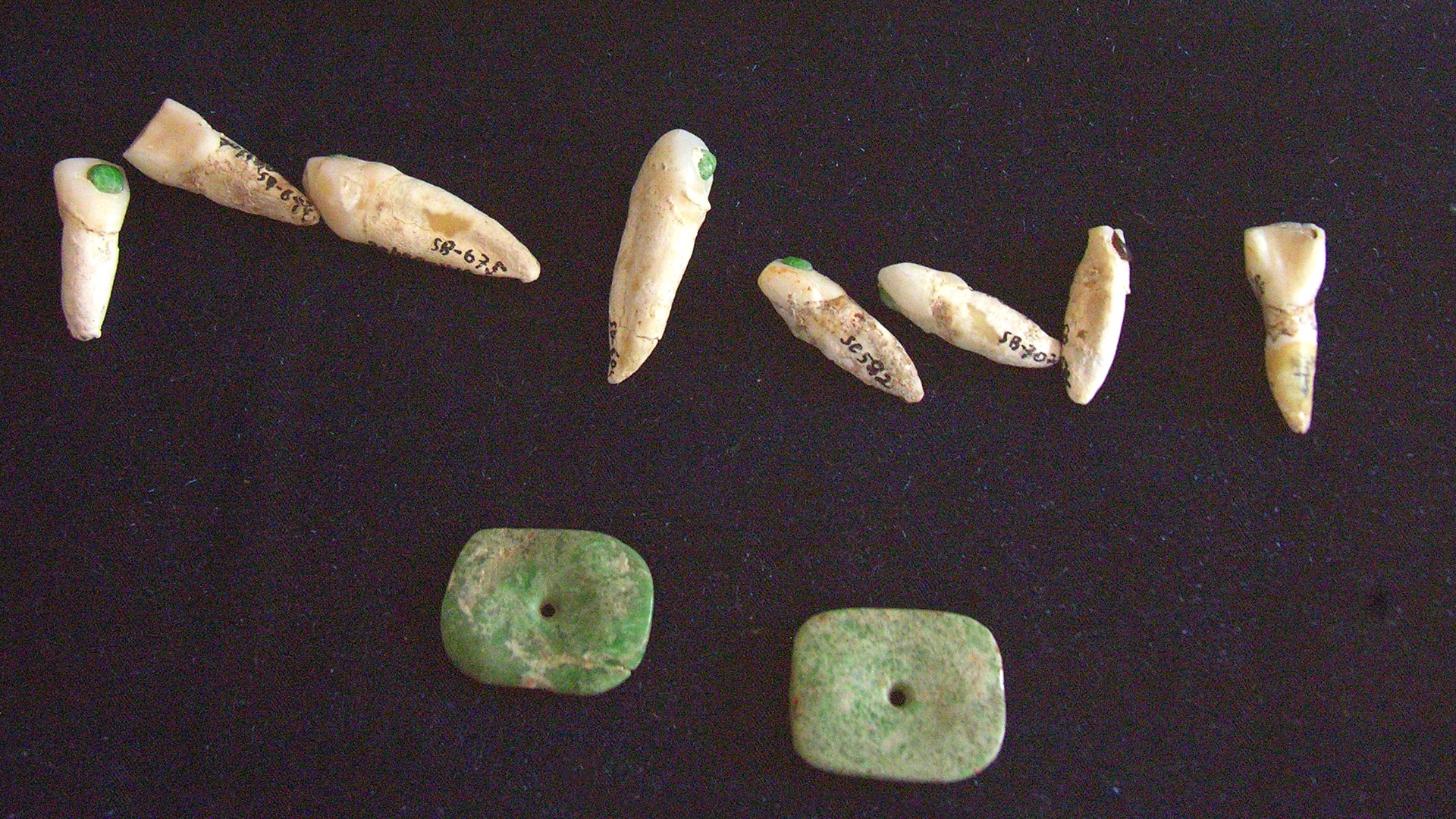 19. Inlays dentaires Maya