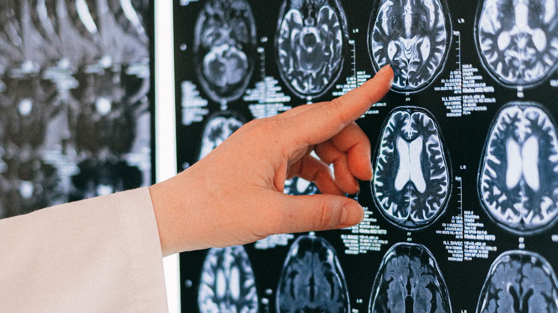 4. Cela augmente votre risque d'AVC