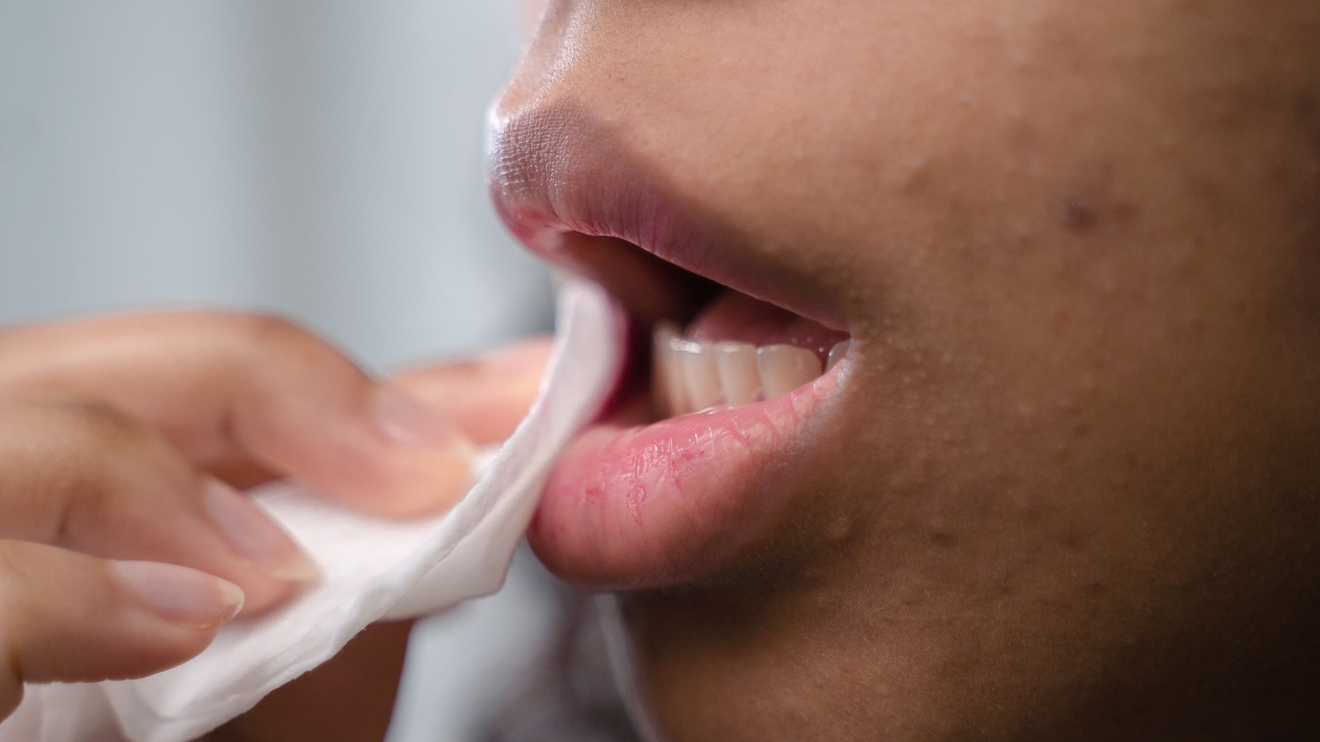 6. Aider à soulager les aphtes bénins