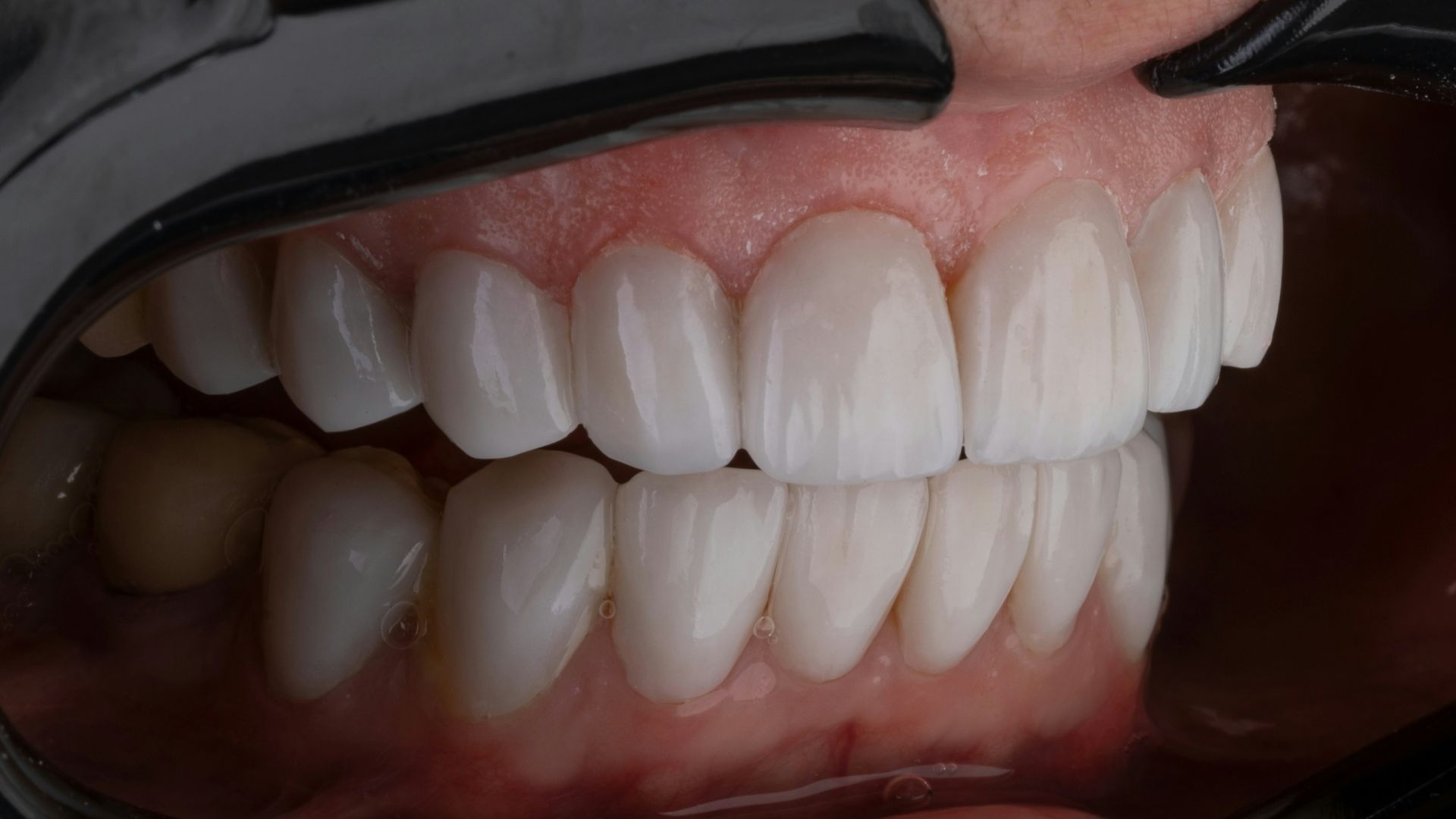 3. Vos dents sont davantage exposées à l'acide