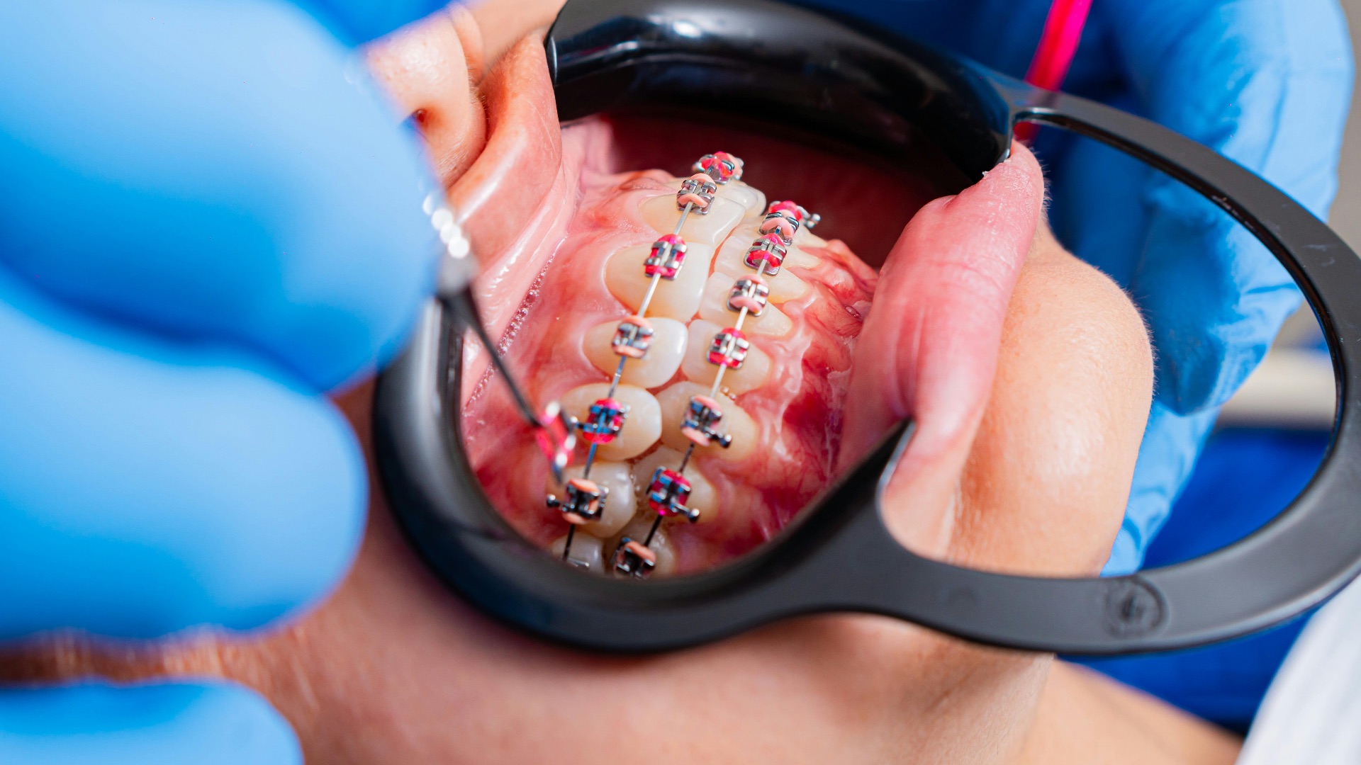 8. Le port précoce d'un appareil dentaire peut améliorer l'hygiène bucco-dentaire à long terme