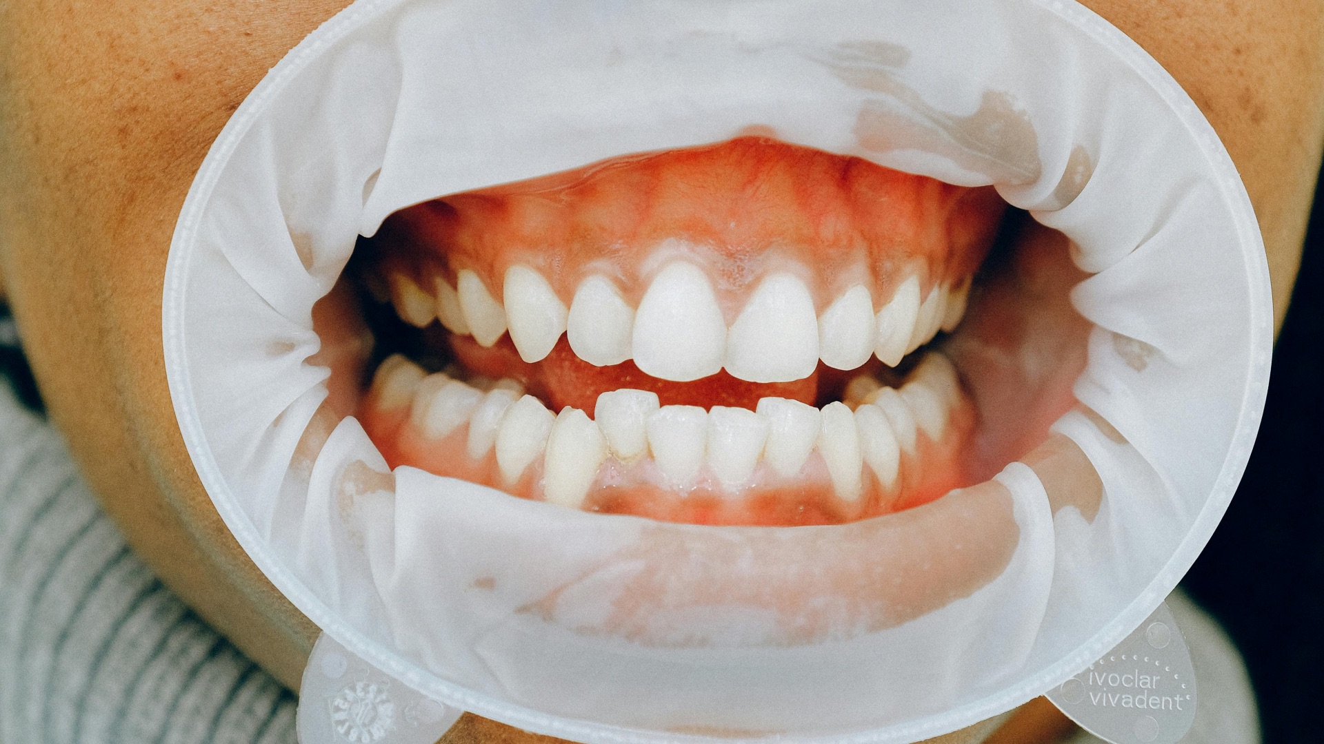 3. Cela peut aider à prévenir des problèmes d'occlusion plus graves