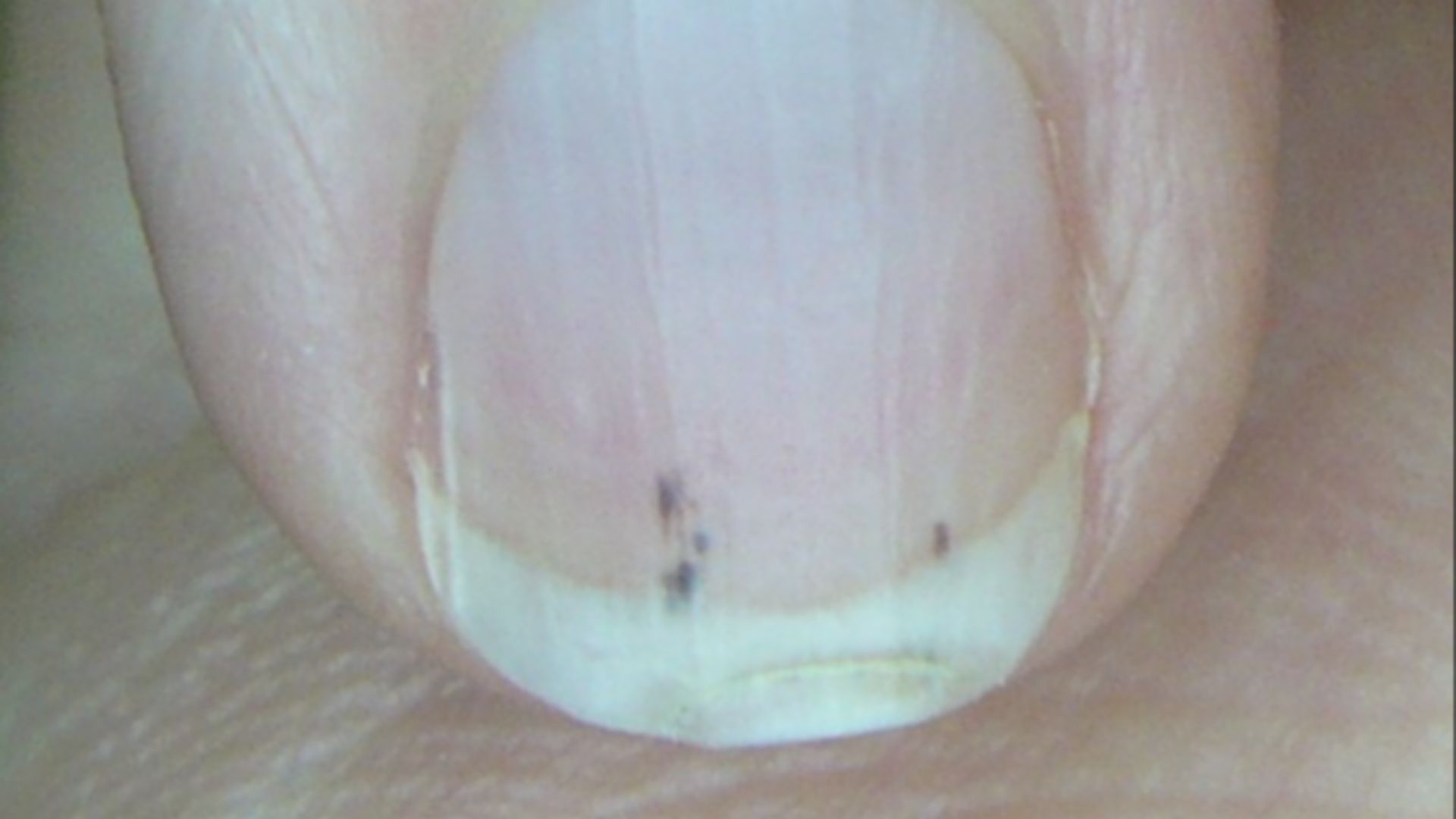 10. Lignes sur les ongles ressemblant à des éclats
