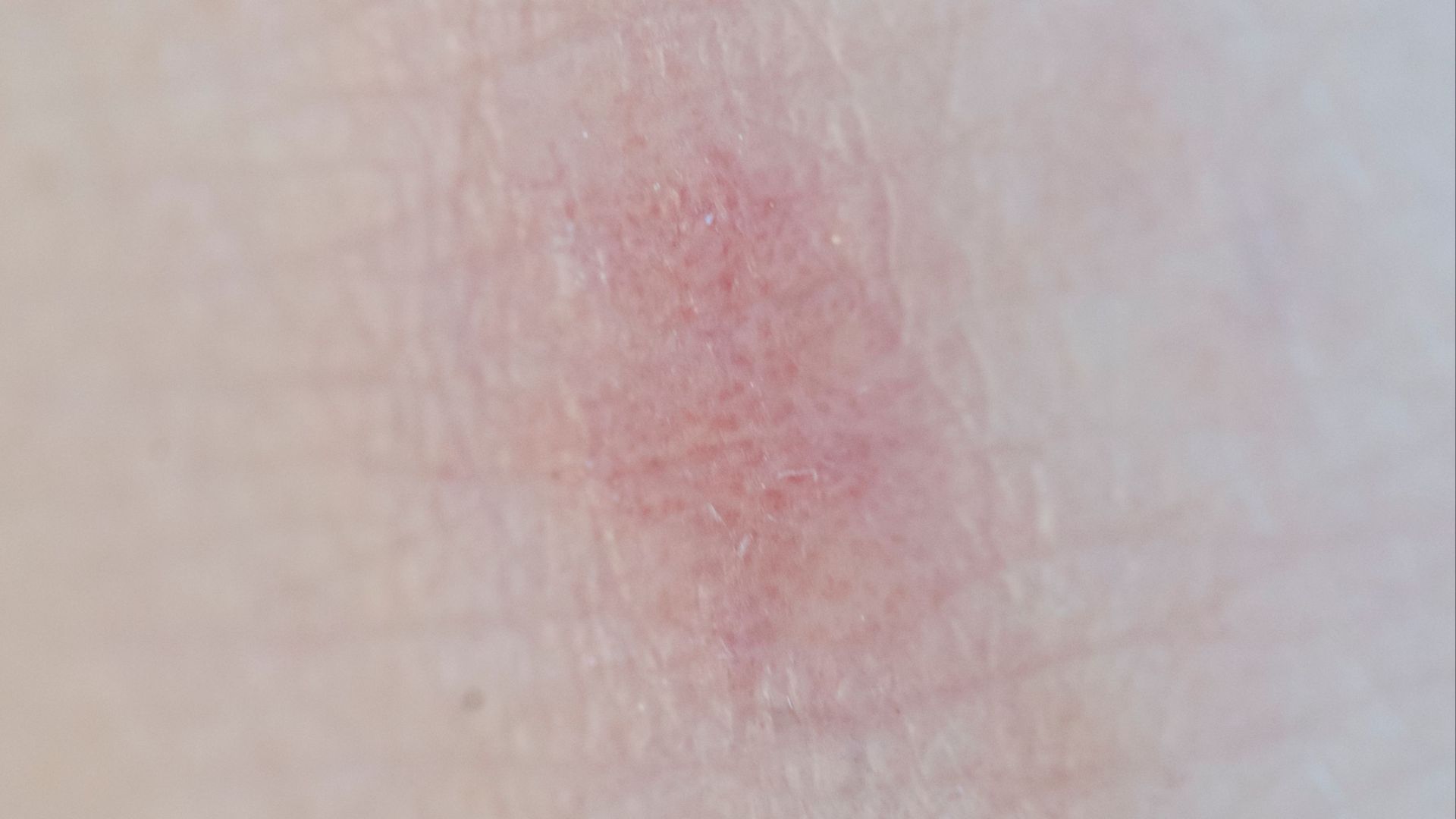 19. Elle réagit aux allergènes par une éruption cutanée