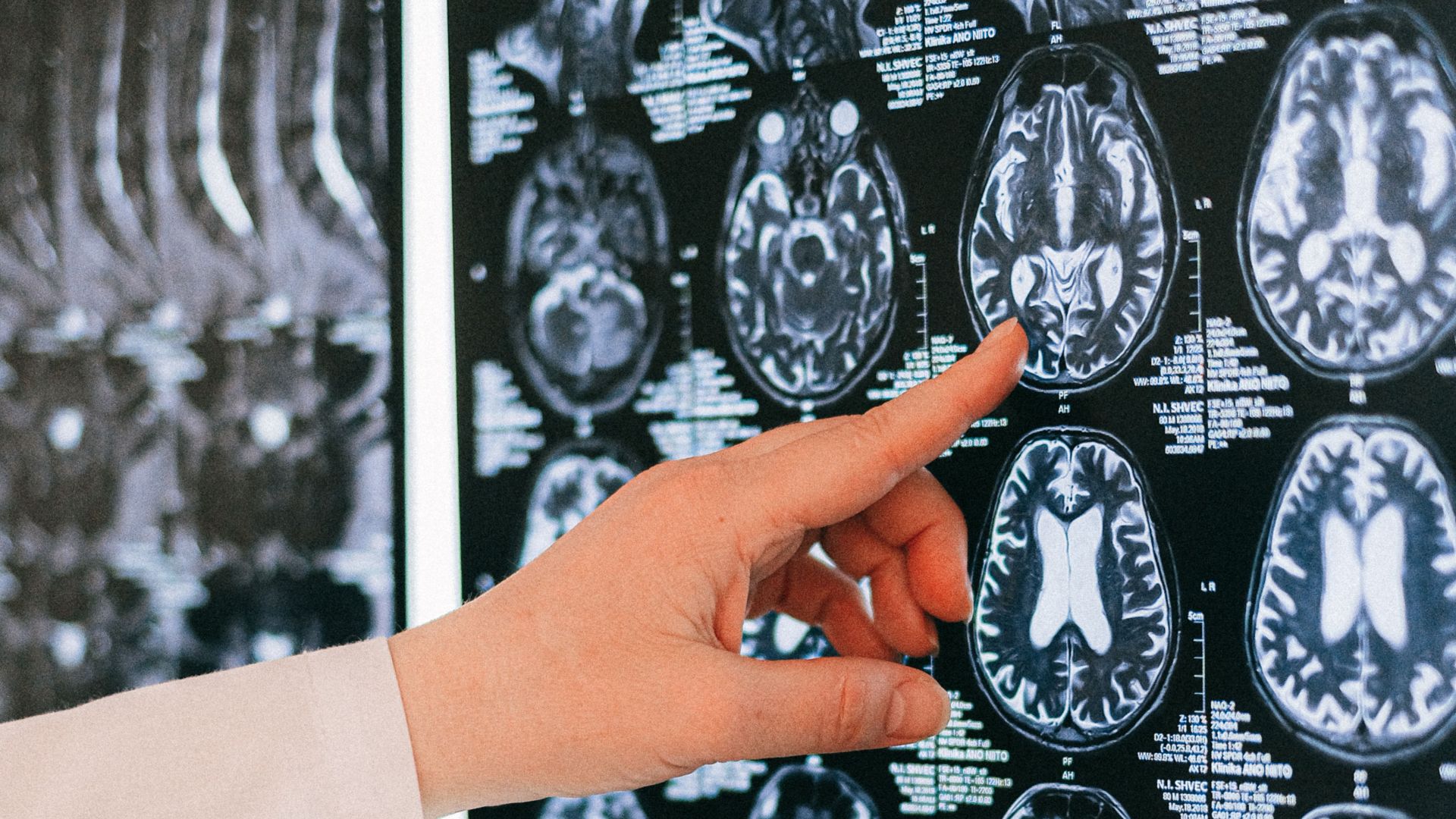 18. L'épilepsie du lobe temporal fait partie du tableau clinique