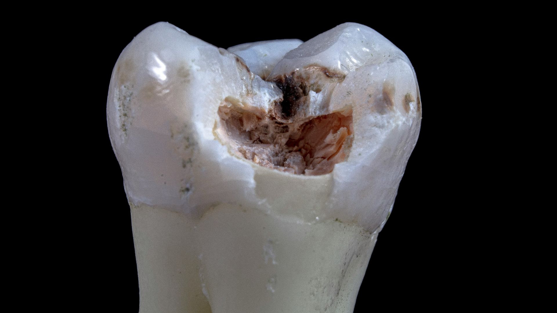 15. Il n'existait pas de véritable remède contre les caries