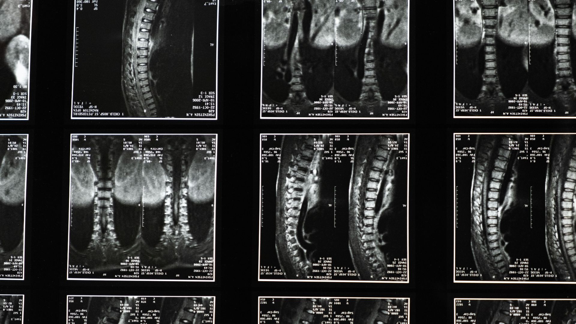 13. Ne jamais passer de densitométrie osseuse