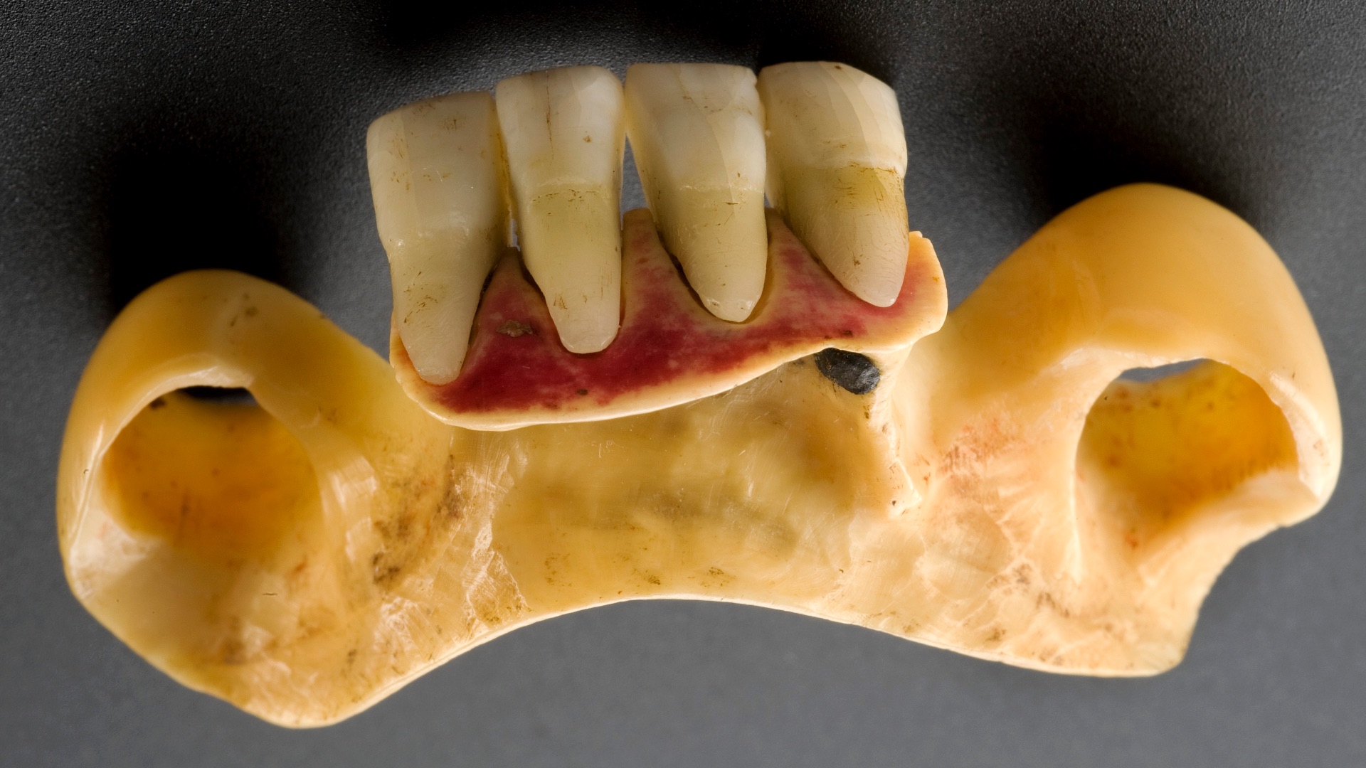 3. Certaines prothèses dentaires contenaient des dents humaines