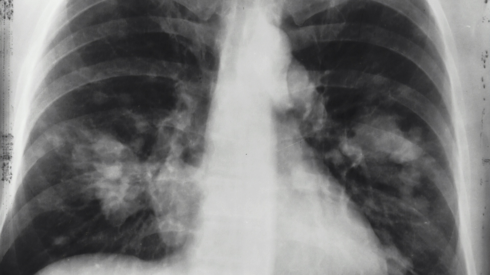 14. Fibrose pulmonaire