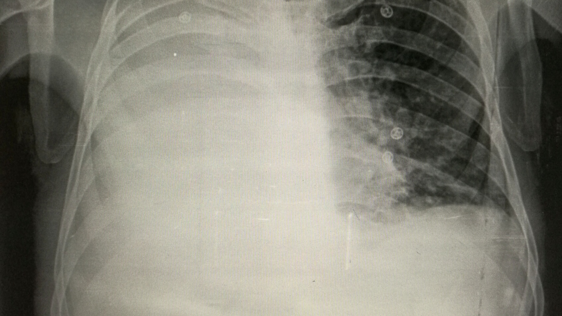 16. Épanchement pleural
