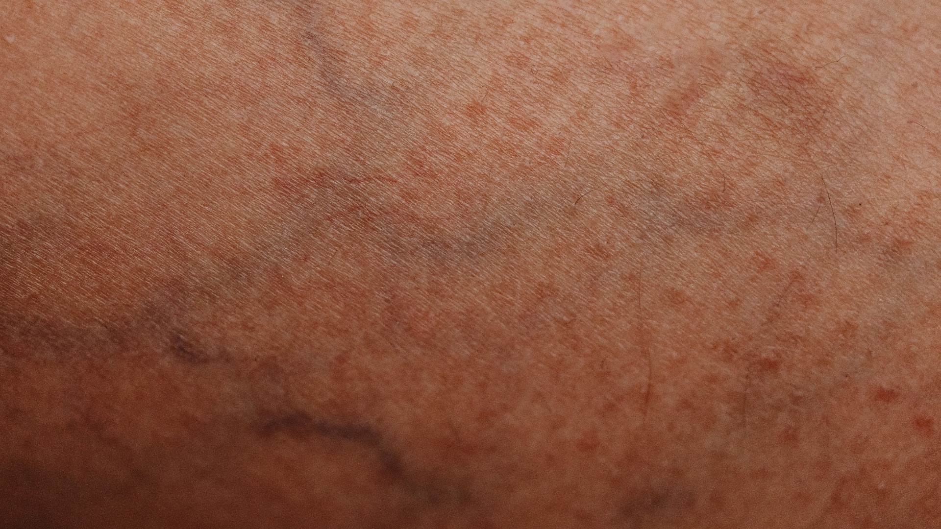 4. Des varices qui ne cessent de se multiplier
