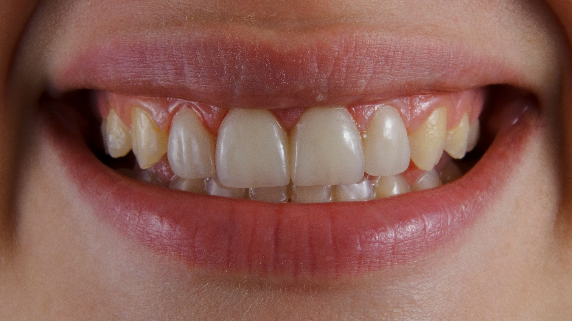 17. Grincement des dents