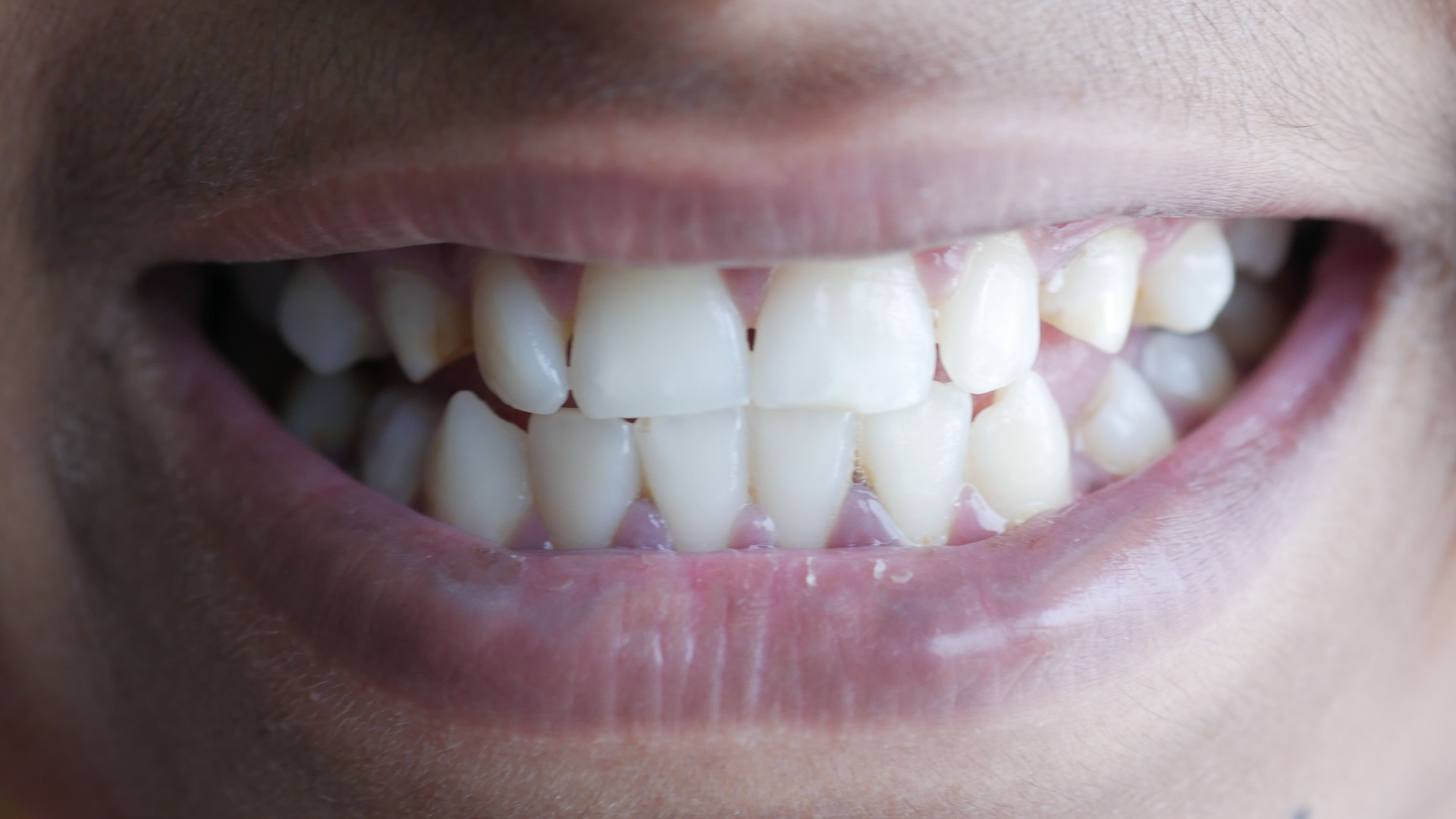 5. Ne considérez pas les saignements des gencives comme normaux