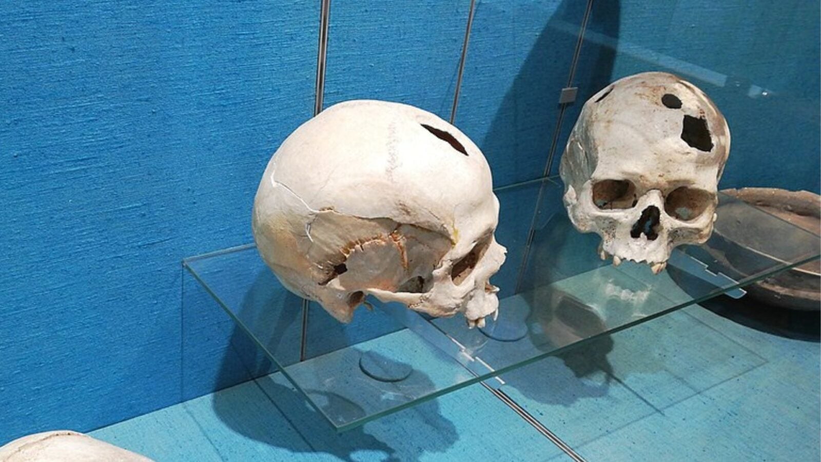 6. Trepanation