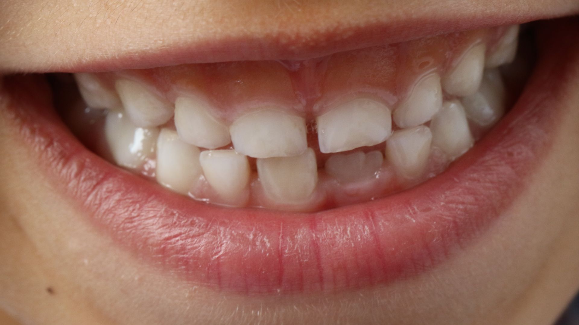 19. Un espace entre les dents de devant