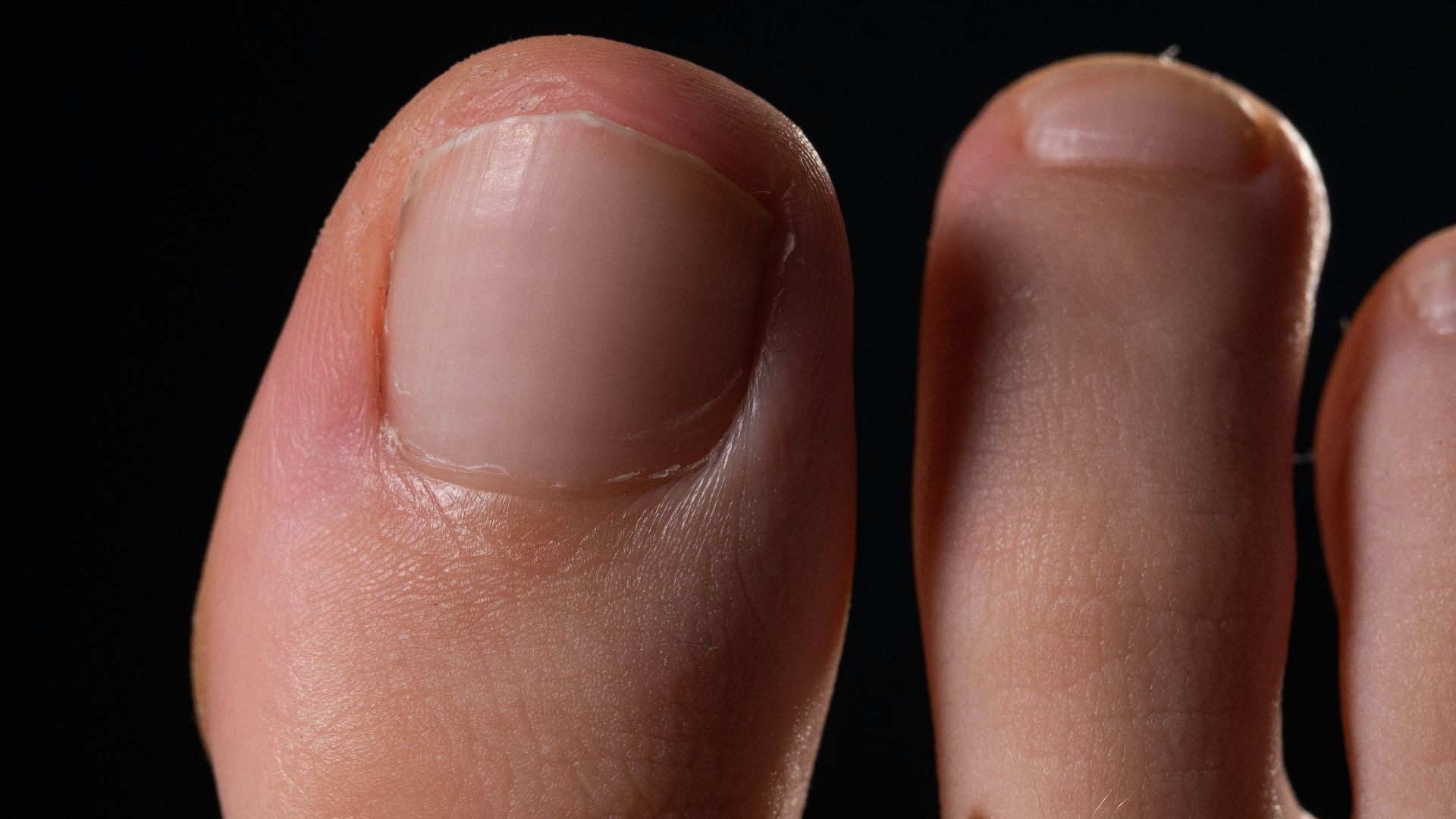 15. Les 87 pouces d'ongles de pied de Louise Hollis