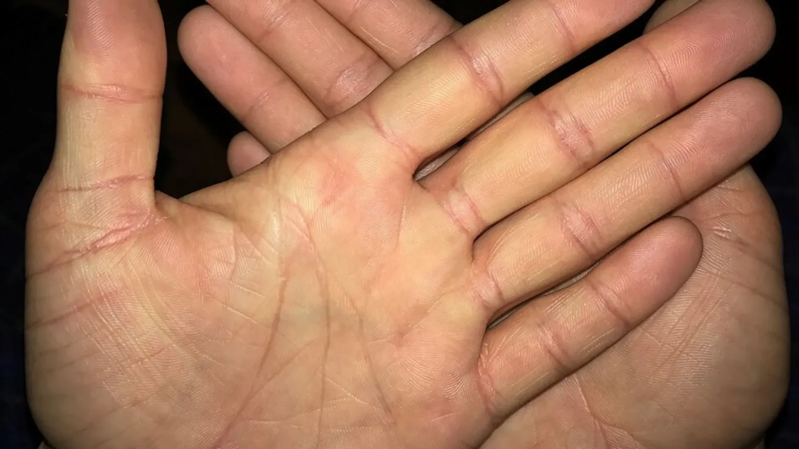 20. Itchy Palms For Money Luck
