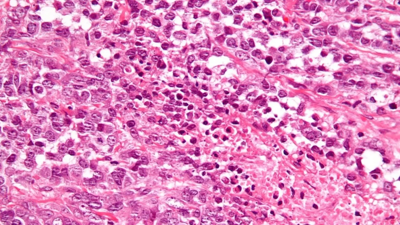 12. Non, on ne sait pas si Marie avait un cancer de l'ovaire