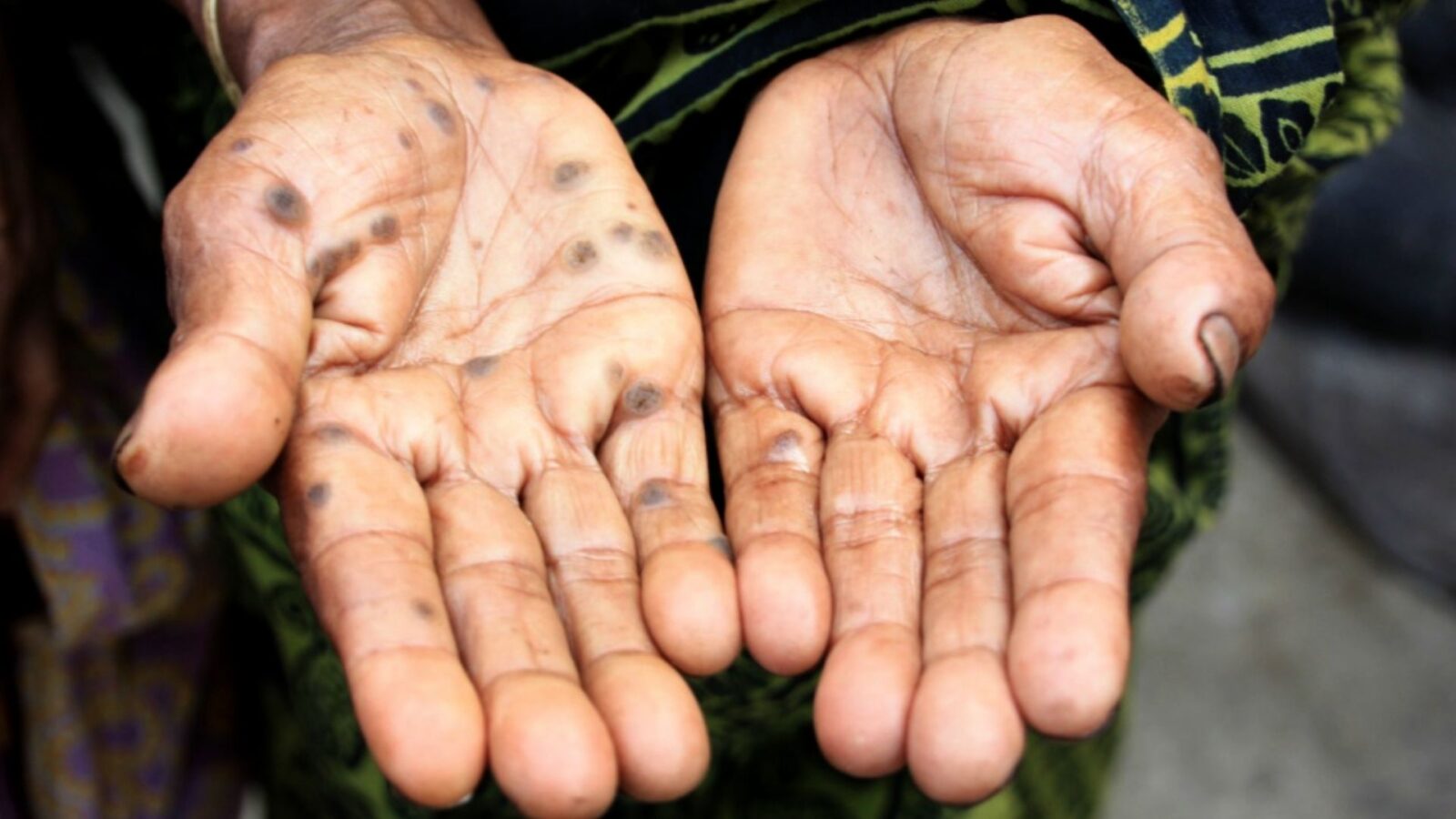 10. Doctors Poisoned Themselves Figuring It Out