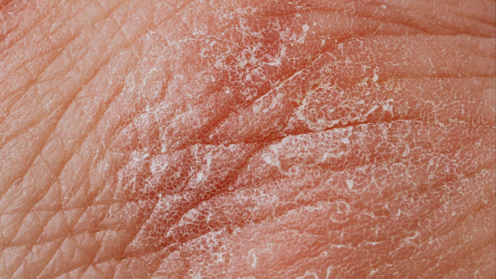 1. L'eczéma