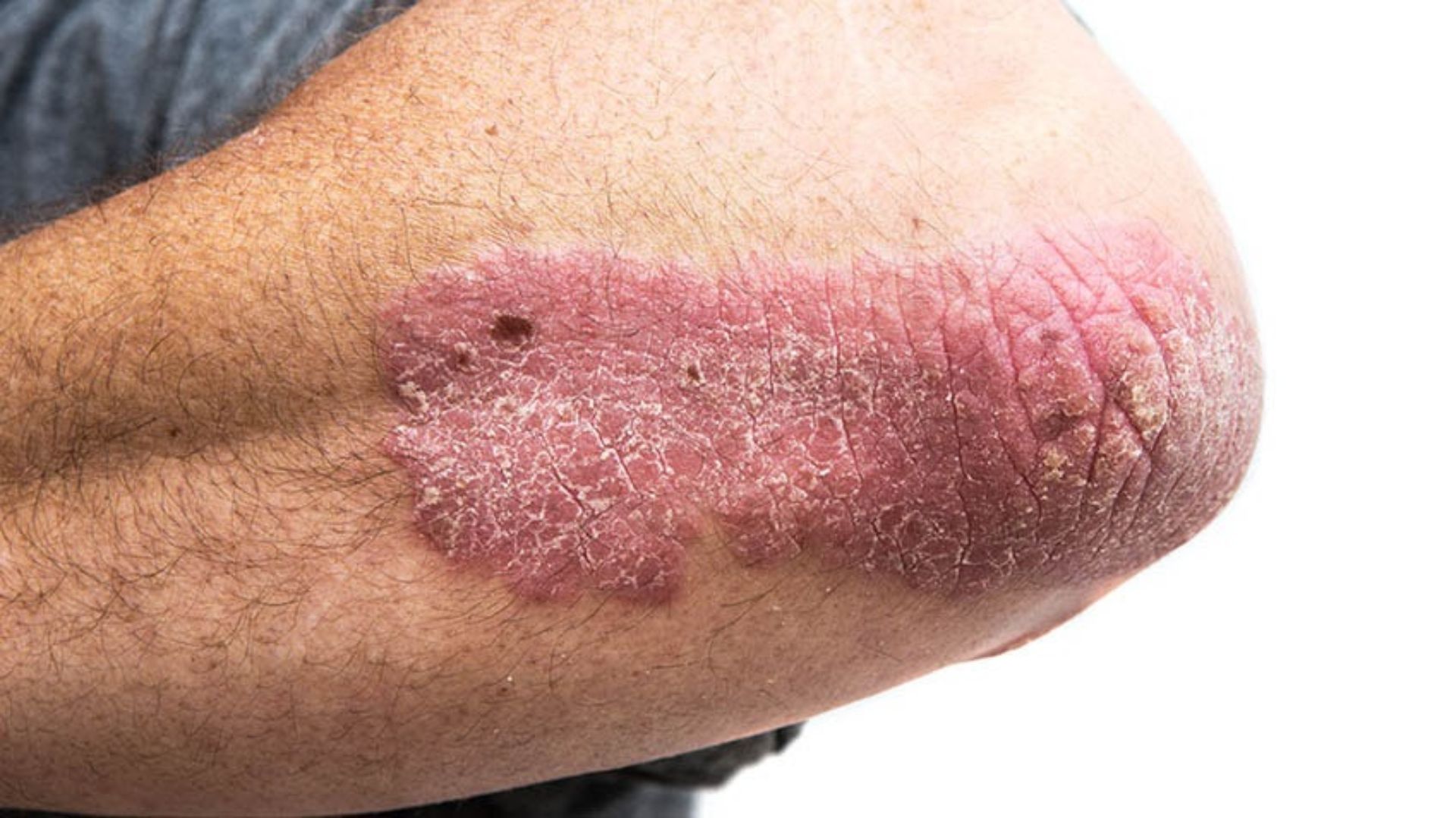 2. Psoriasis